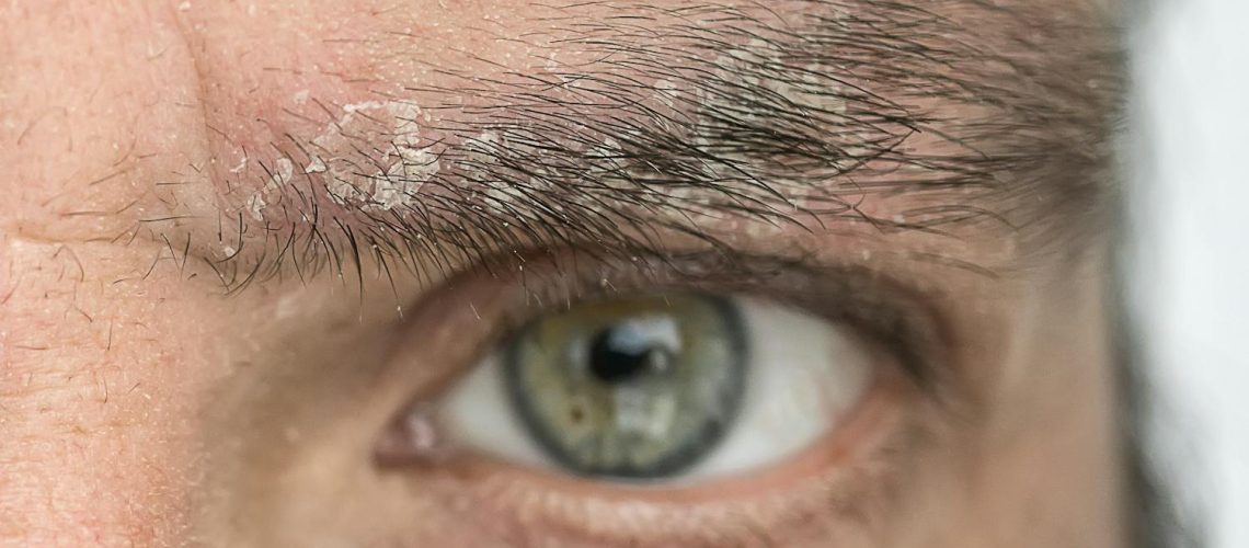 Pourquoi des pellicules apparaissent-elles sur vos sourcils ?